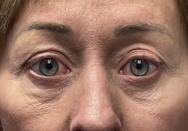 Before Laser Resurfacing Before Laser Resurfacing
